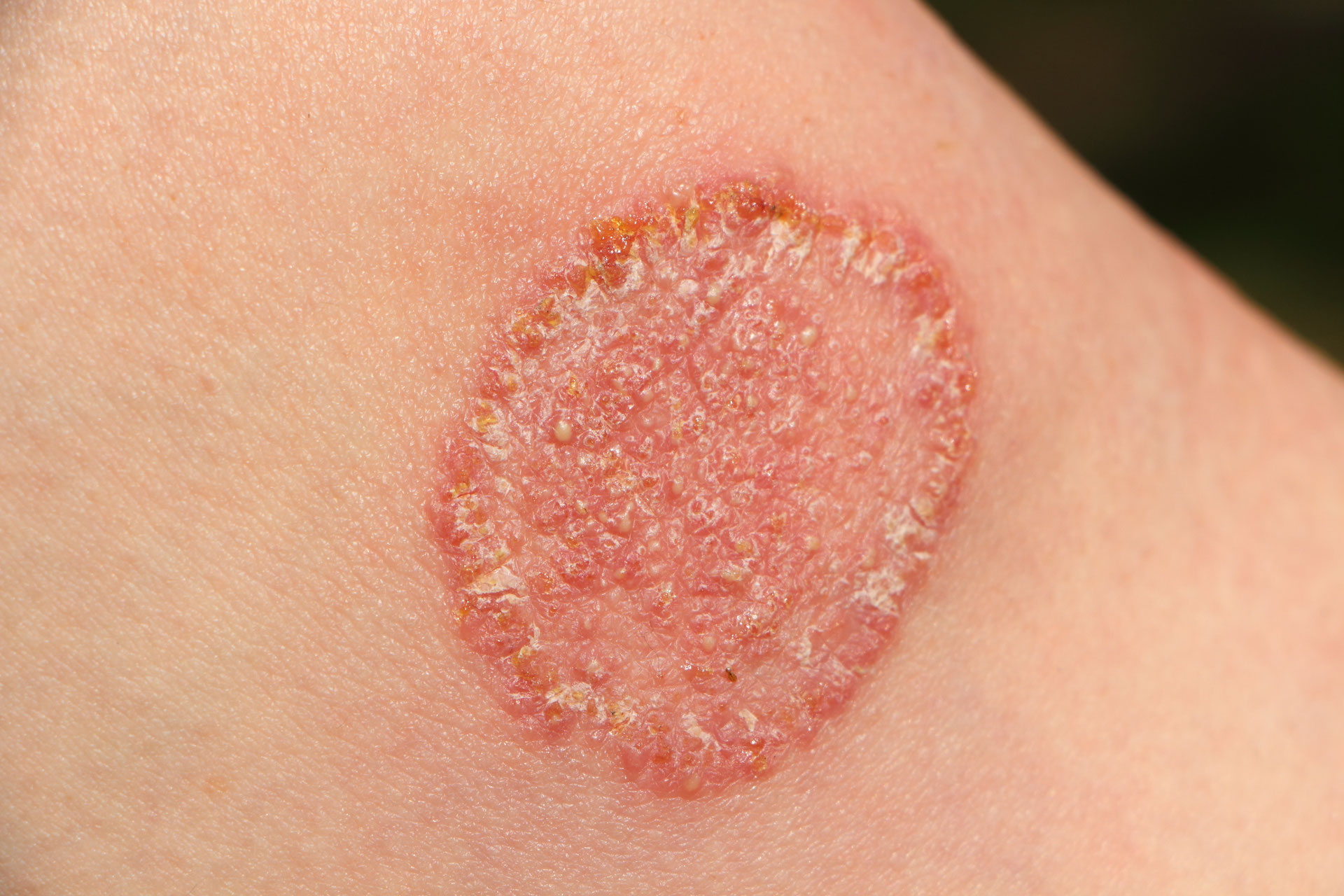 Frühlingssonne genießen - Hautkrebs vermeiden: Deutsche Krebshilfe und Arbeitsgemeinschaft Dermatologische Prävention geben einfache Tipps gegen Hautkrebs