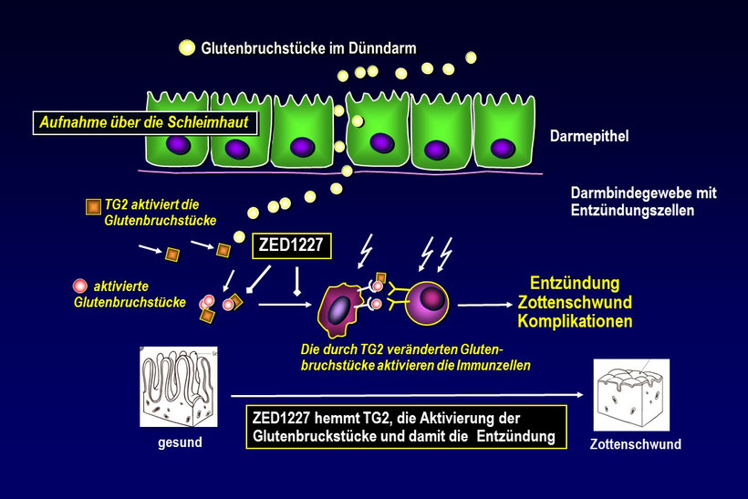 Bildunterschrift: Das neue Z&ouml;liakie-Medikament ZED1227 hemmt die &uuml;berschie&szlig;ende Aktivit&auml;t des Enzyms TG2 in der D&uuml;nndarmschleimhaut und unterbindet so die durch Gluten herbeigef&uuml;hrte Entz&uuml;ndung.  Bildquelle: &copy; Schuppan D. / Universit&auml;tsmedizin Mainz