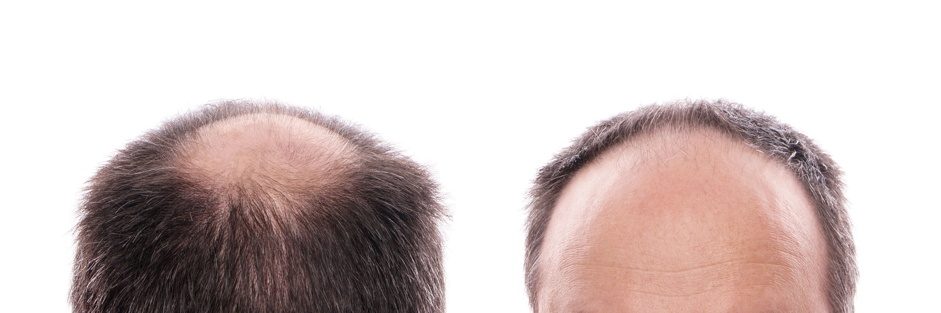 Haarausfall: Ursachen und Behandlung