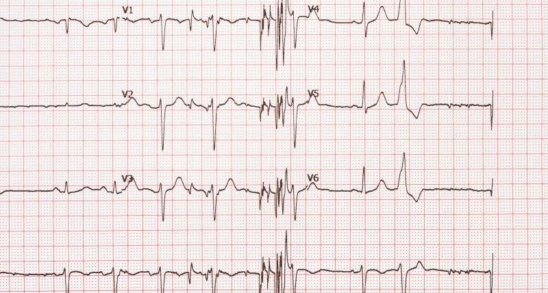 Vorhofflimmern: Frühe Katheterablation erzielt langfristig bessere Ergebnisse als Medikamente