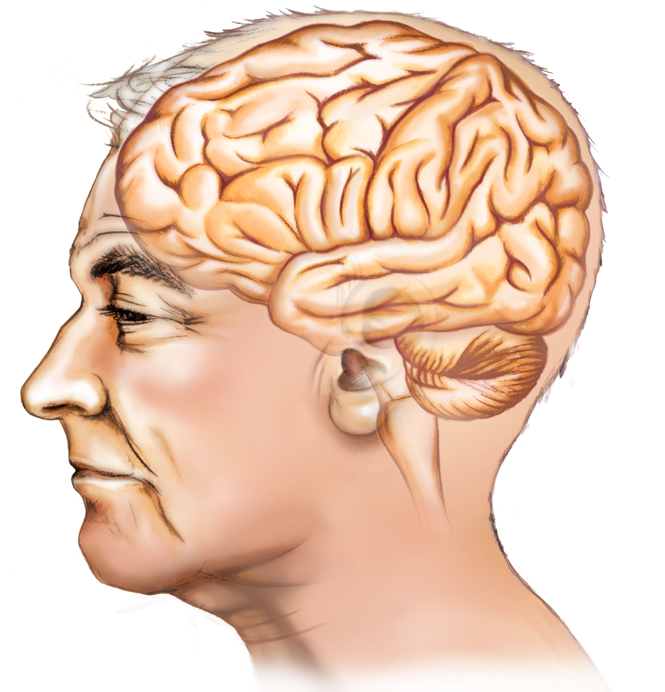 Leqembi: Zulassungsempfehlung für neues Alzheimer-Medikament bestätigt