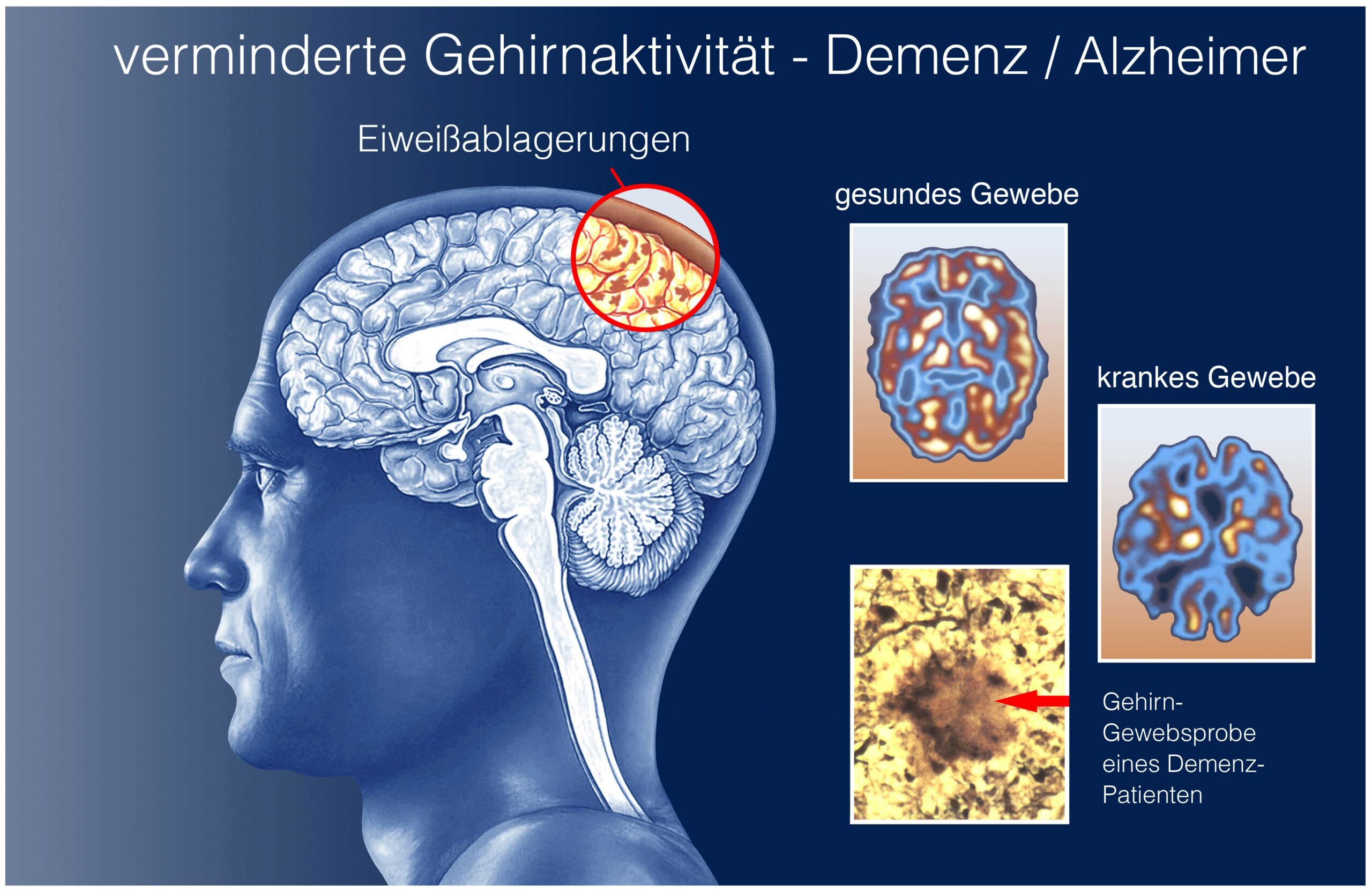 Prof. Stefan Teipel über das Alzheimermedikament Leqembi