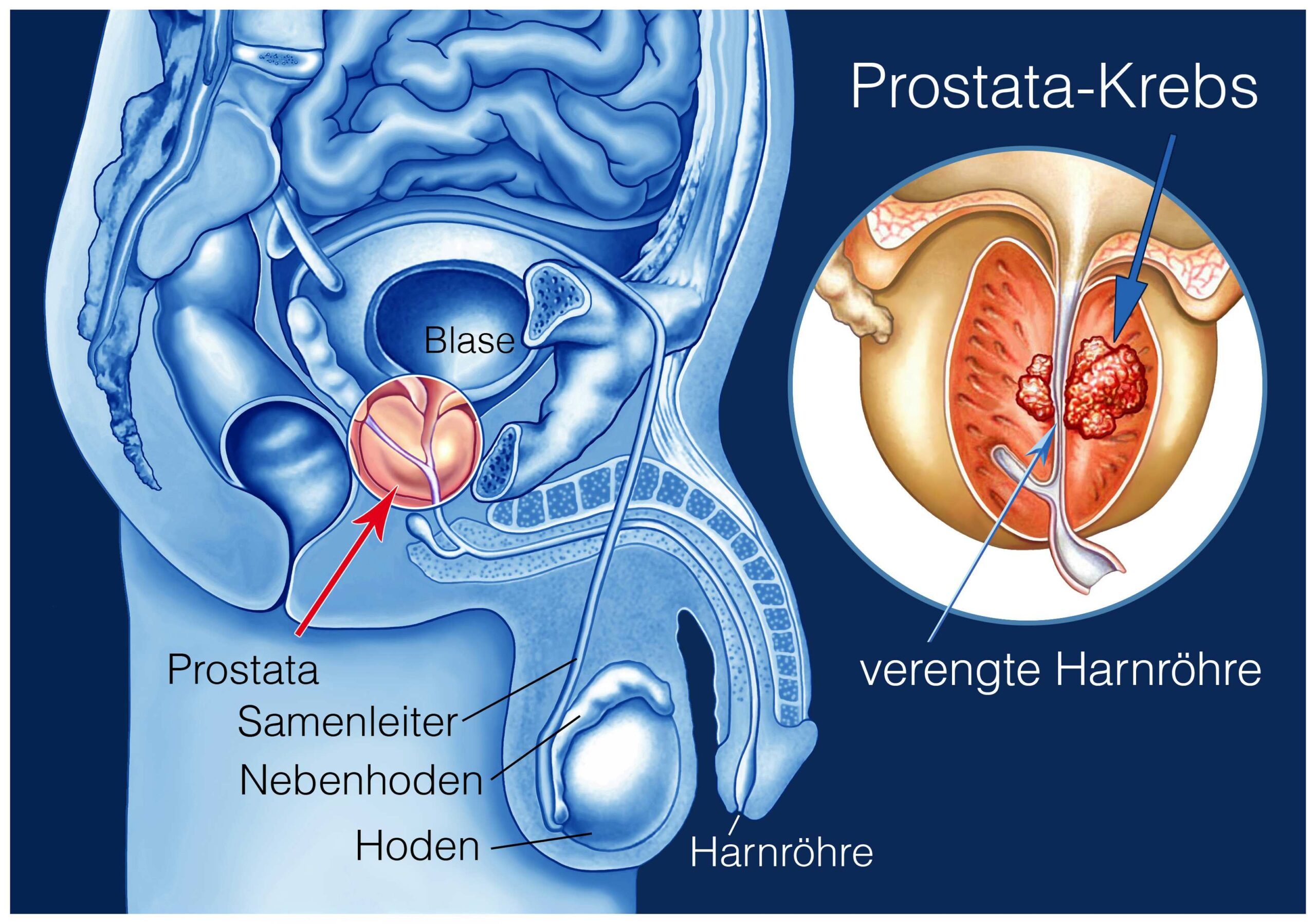 Ärzteblatt.de: Rektale Tastuntersuchung ungeeignet für Prostatakrebs